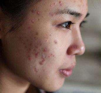 不花钱也能有效对抗油性痘痘肌