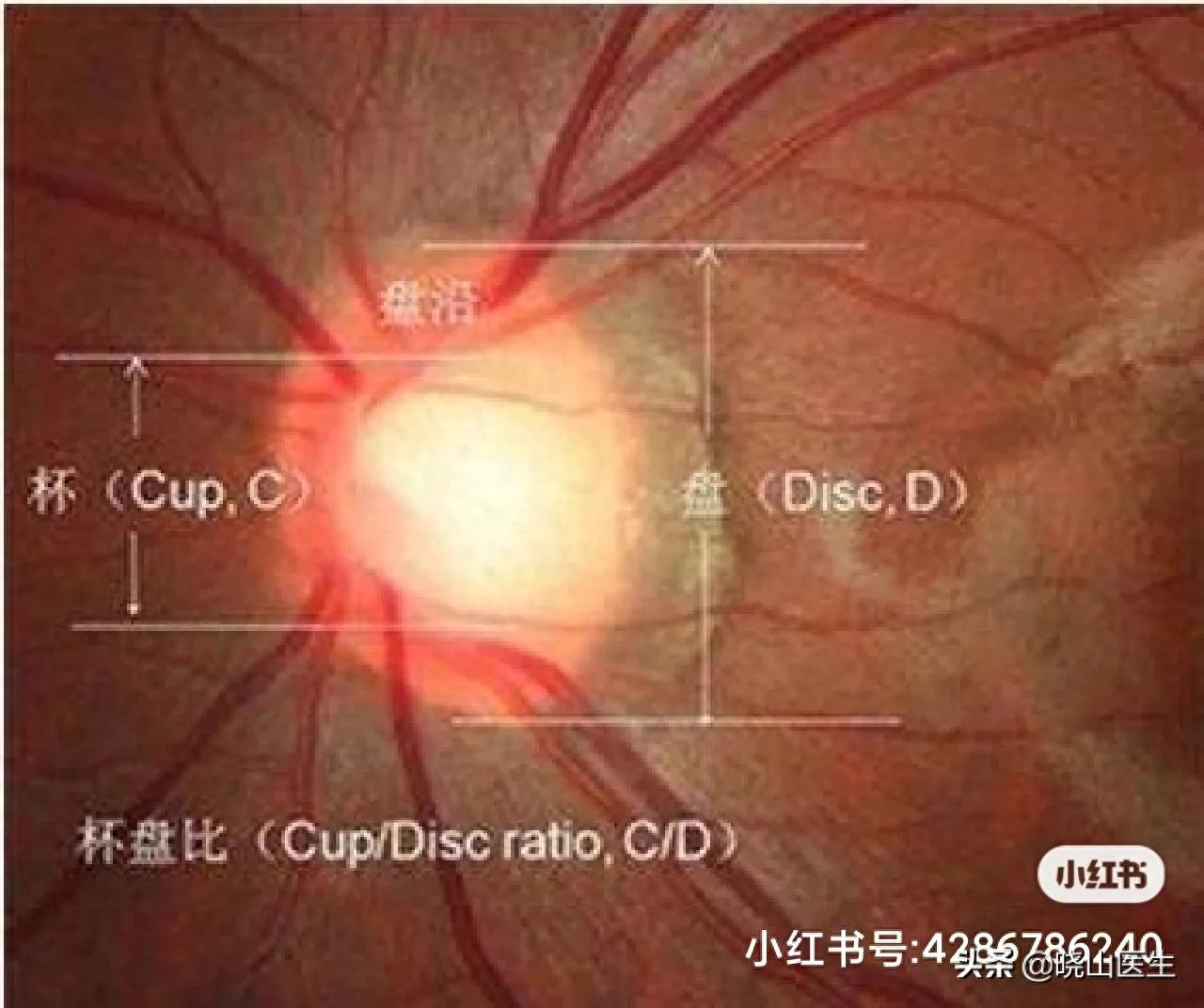 了解青光眼: Eye Tech Care