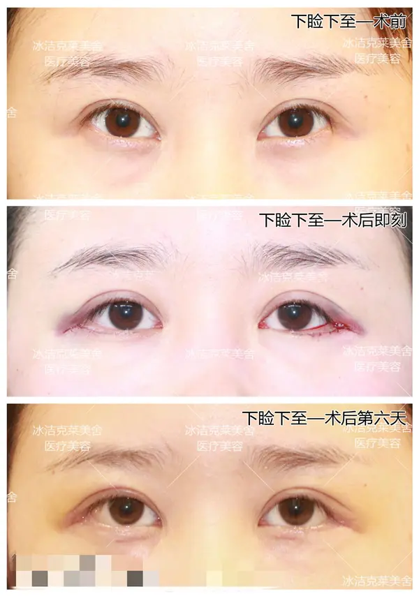 下睑下置 改善吊眼 还你温柔的眼神丨张冰洁下睑下至案例 哔哩哔哩