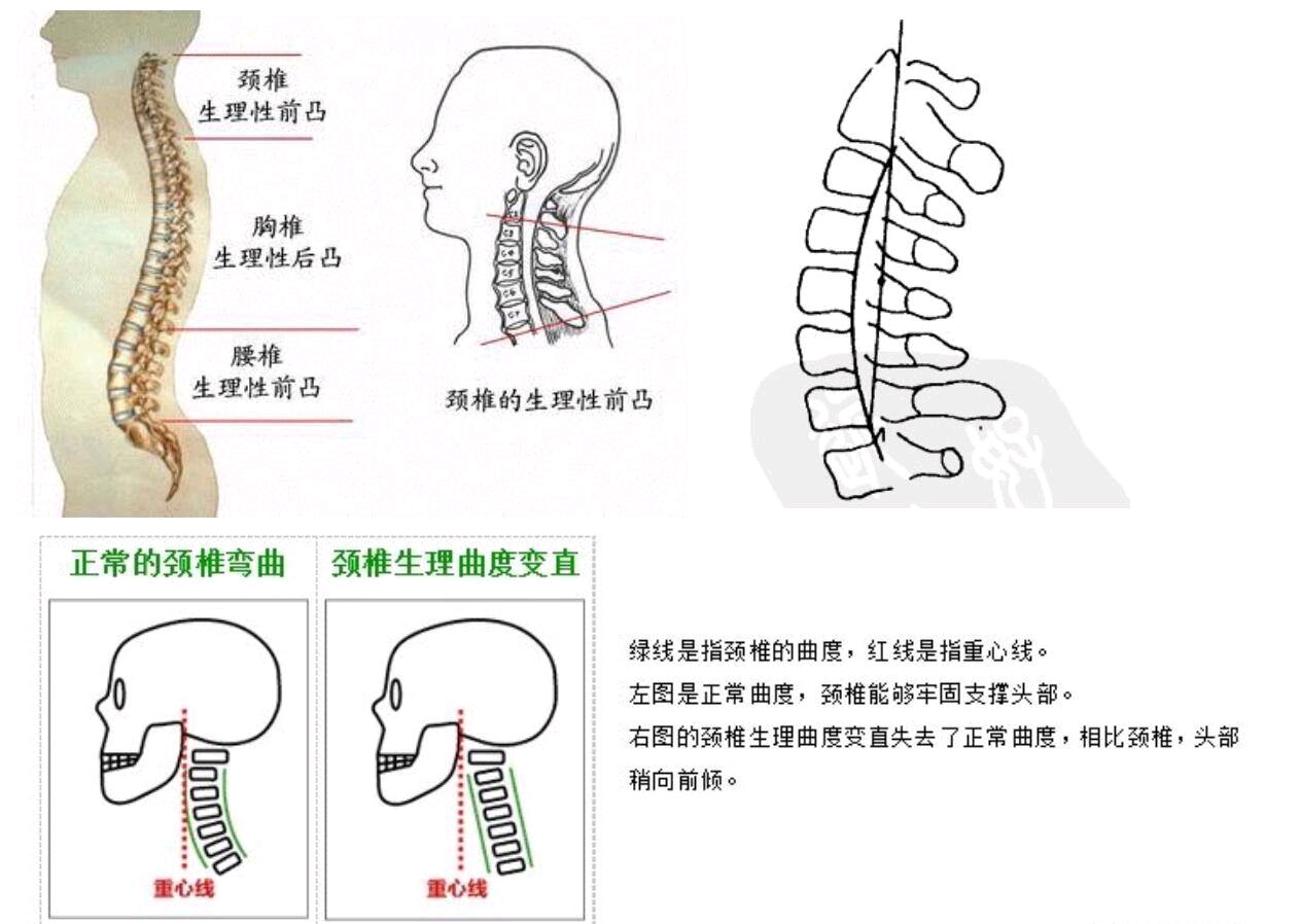 颈椎病之颈椎生理曲度消失的防治（视频） - 知乎