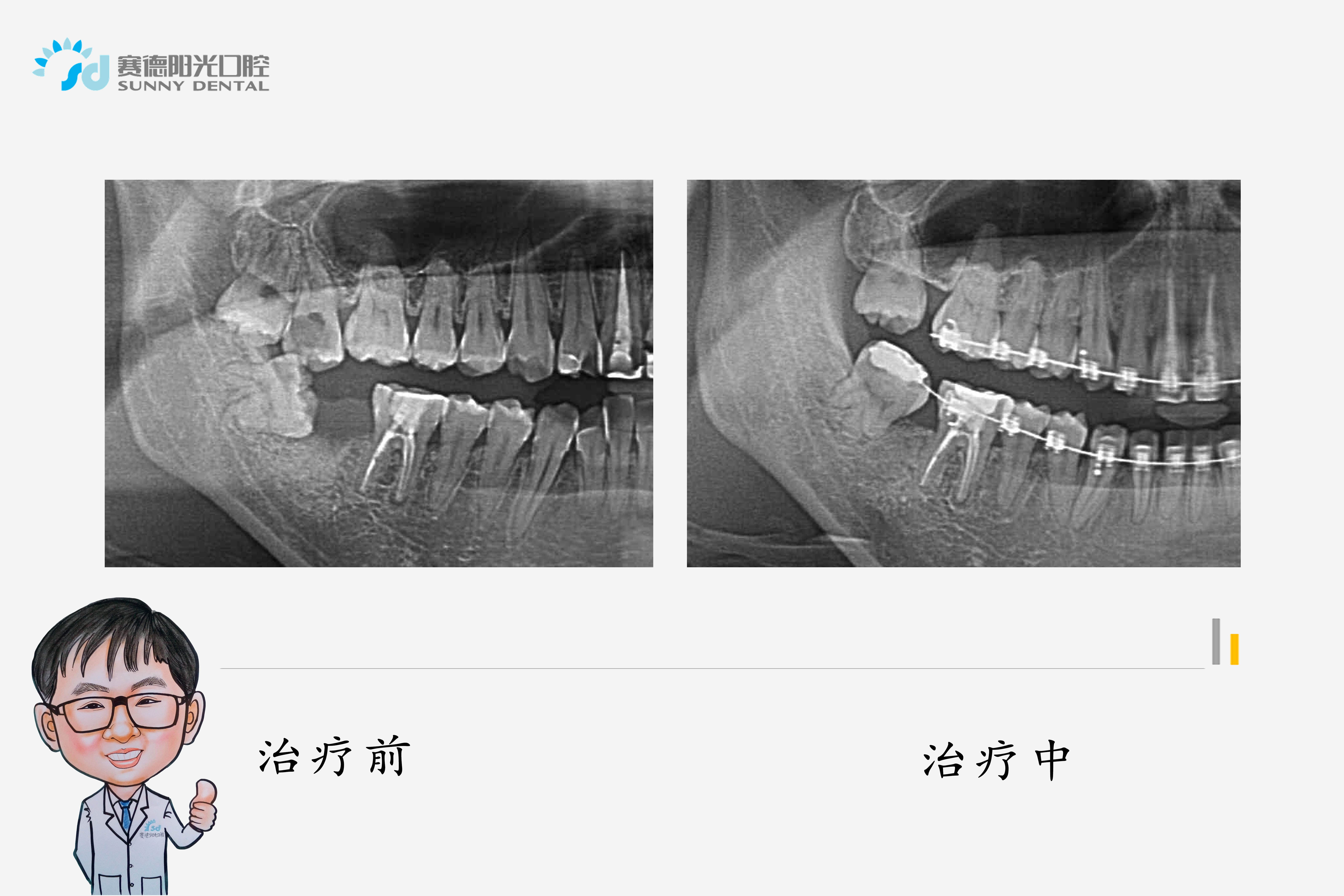 (四)下颌第二磨牙-牙体组织与解剖形态彩色图谱-医学