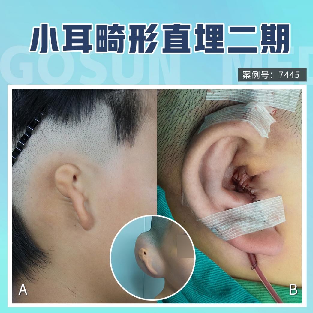 耳垂裂（じすいれつ）、耳切れの手術 | 神楽坂肌と爪のクリニック
