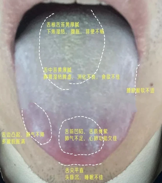 舌象分析 - 哔哩哔哩