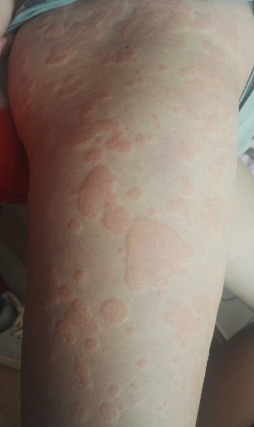 荨麻疹怎么从根治疗