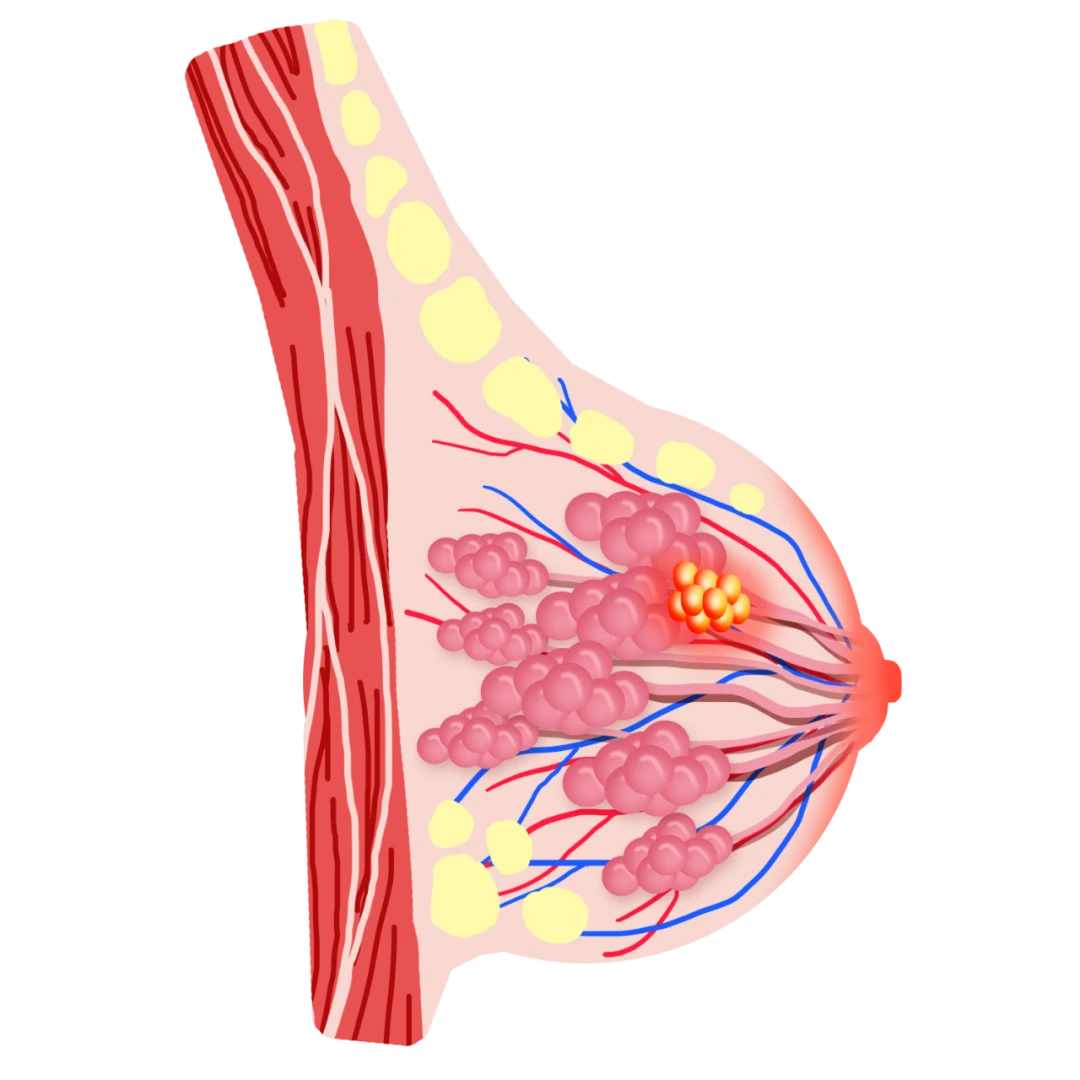 当你有乳腺结节了，距离乳腺癌有多远？ 哔哩哔哩