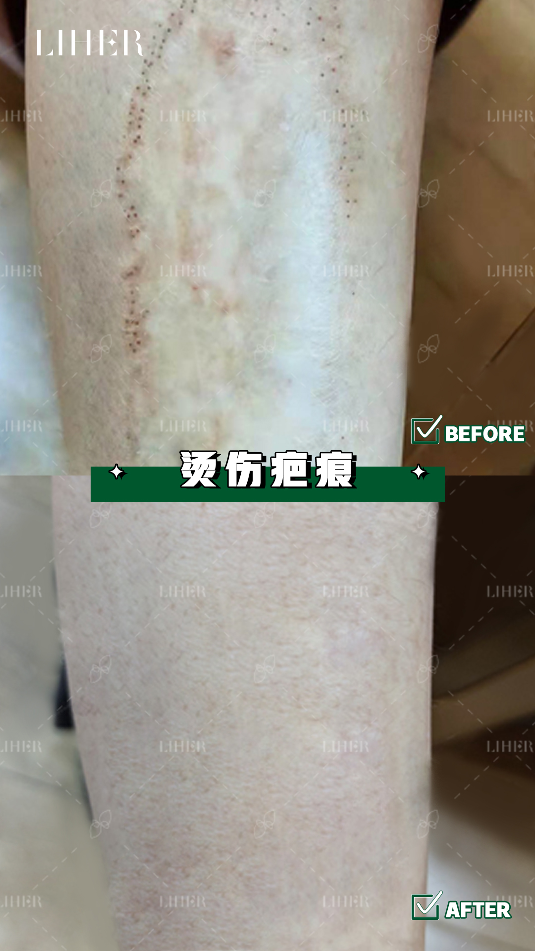 吃瓜网友科普：为什么是疤痕体质？深度解析与照护建议