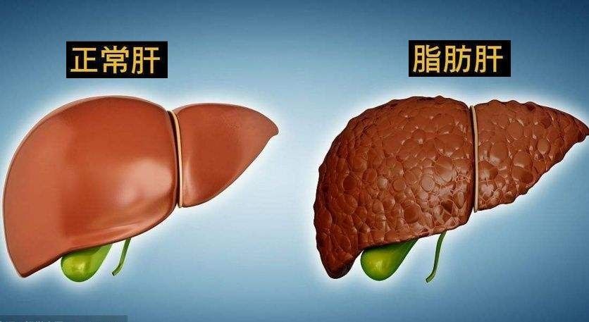 如何预防脂肪肝 哔哩哔哩