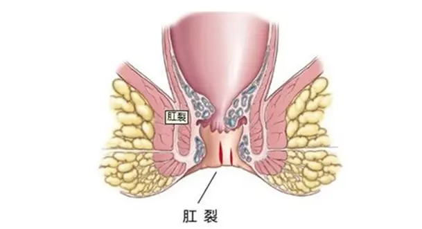 肛裂怎么治疗好的快 哔哩哔哩
