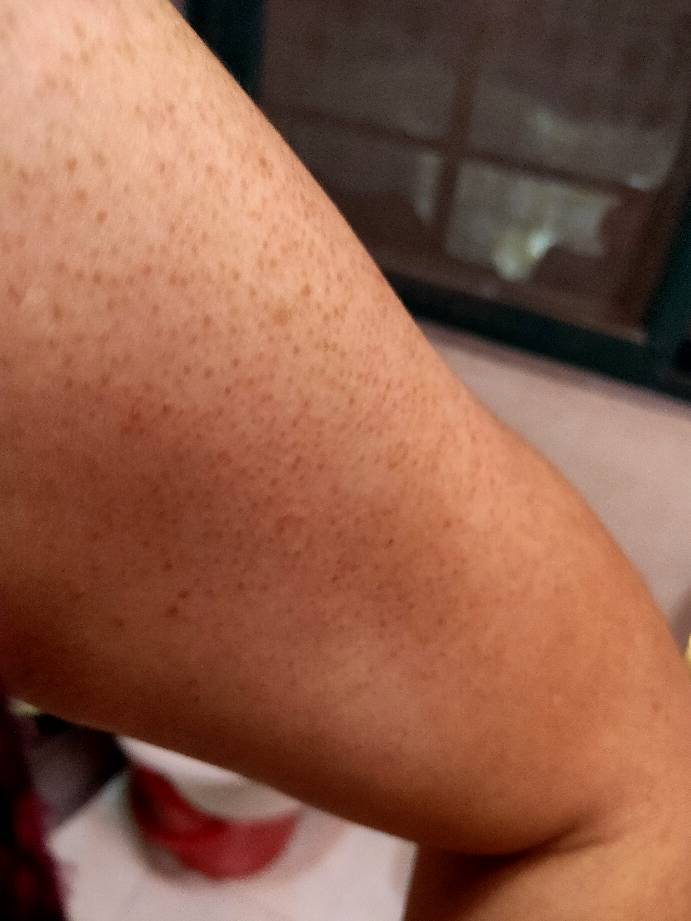 鸡皮肤的红点点怎么办(鸡皮肤红点点为什么治不好)