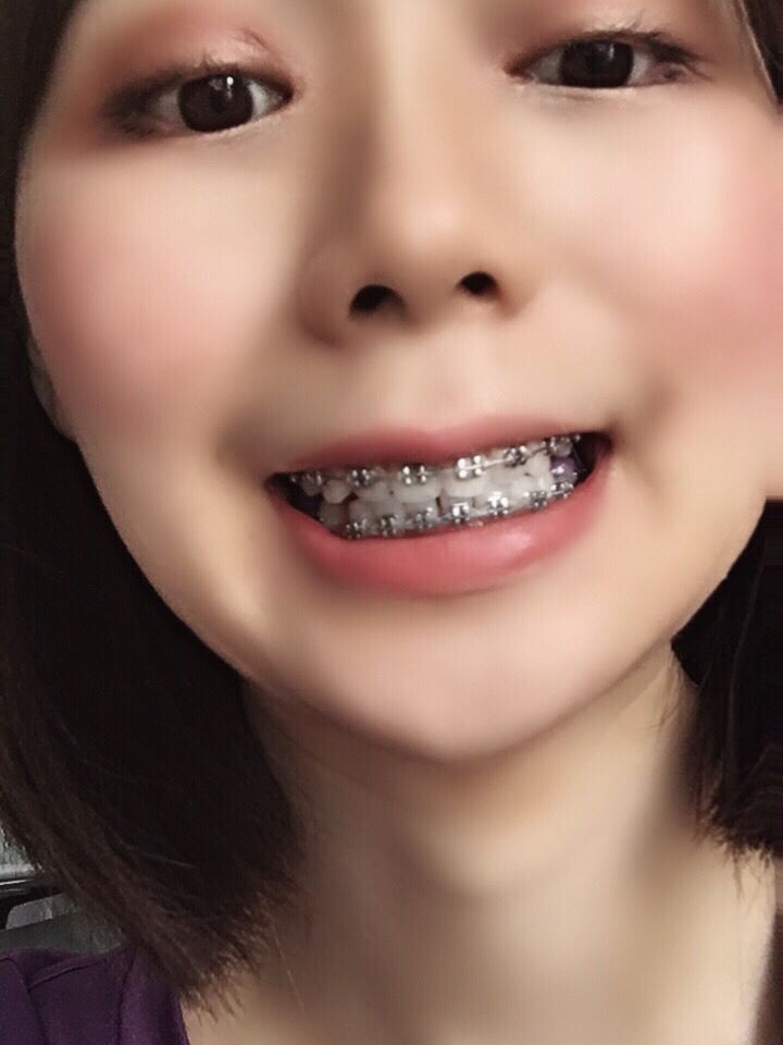 想戴牙套的小姐妹有条件还是选择自锁牙套吧!