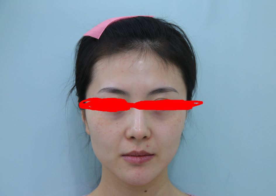 乔爱军医生案例分析看看我丰满的苹果肌和额头太阳穴呀我不会告诉你我