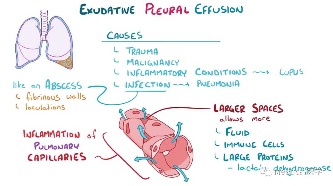 an  exudative pleural effusion is due to inflammation of the