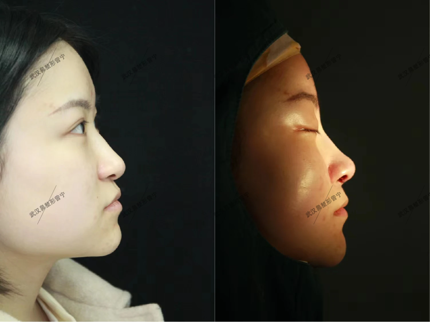改善鼻孔不对称、鼻小柱偏曲、假体轮廓明显、鼻翼缘后缩、鼻基底凹陷术后7天效果 - 知乎