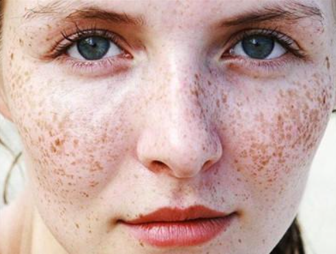 斑,太田斑……这麽多种类的色斑,你分得清哪些是浅层斑,哪些是深层斑