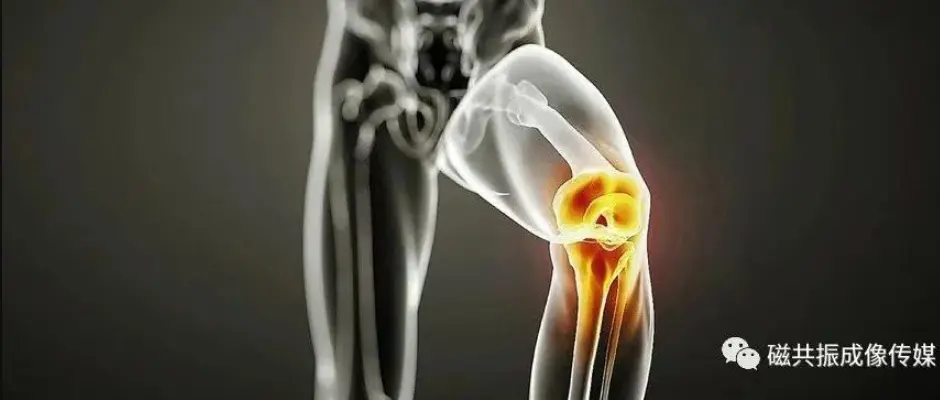 Mri T2 Mapping纹理特征在膝关节骨性关节炎软骨损伤分级中的价值 哔哩哔哩