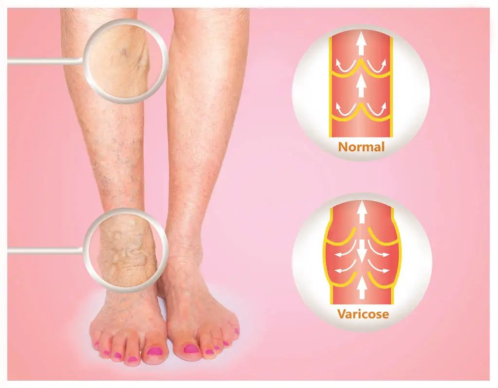 嚴重的靜脈曲張腿部怎樣治療,對血管好的食物一定要試試
