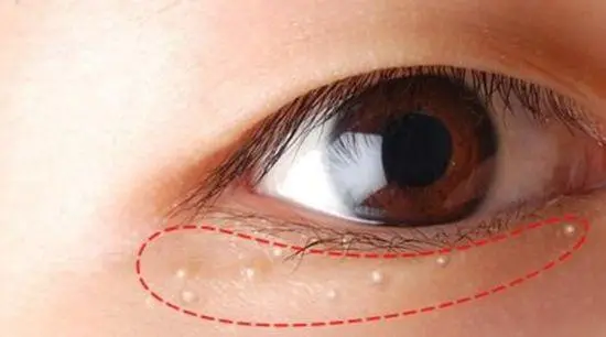 脂肪粒 眼周长脂肪粒影响颜值 这几招教你轻松去除眼周脂肪粒 哔哩哔哩