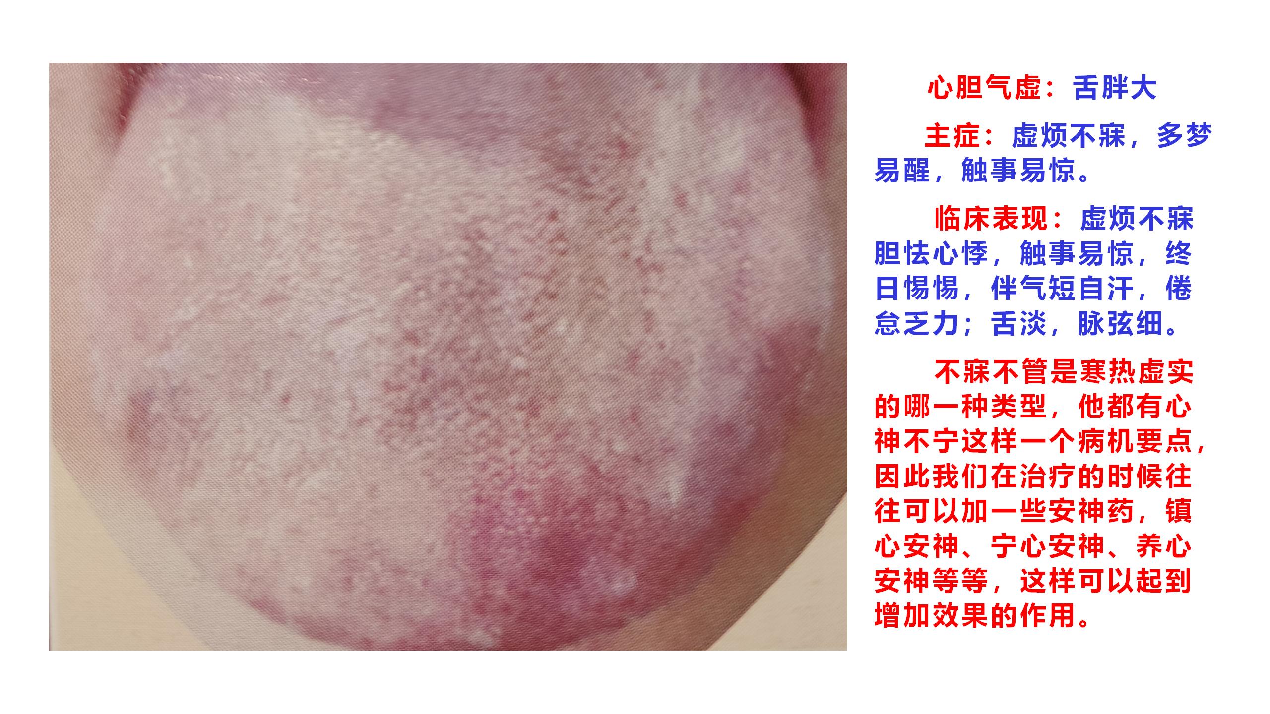 失眠：心胆气虚证 哔哩哔哩