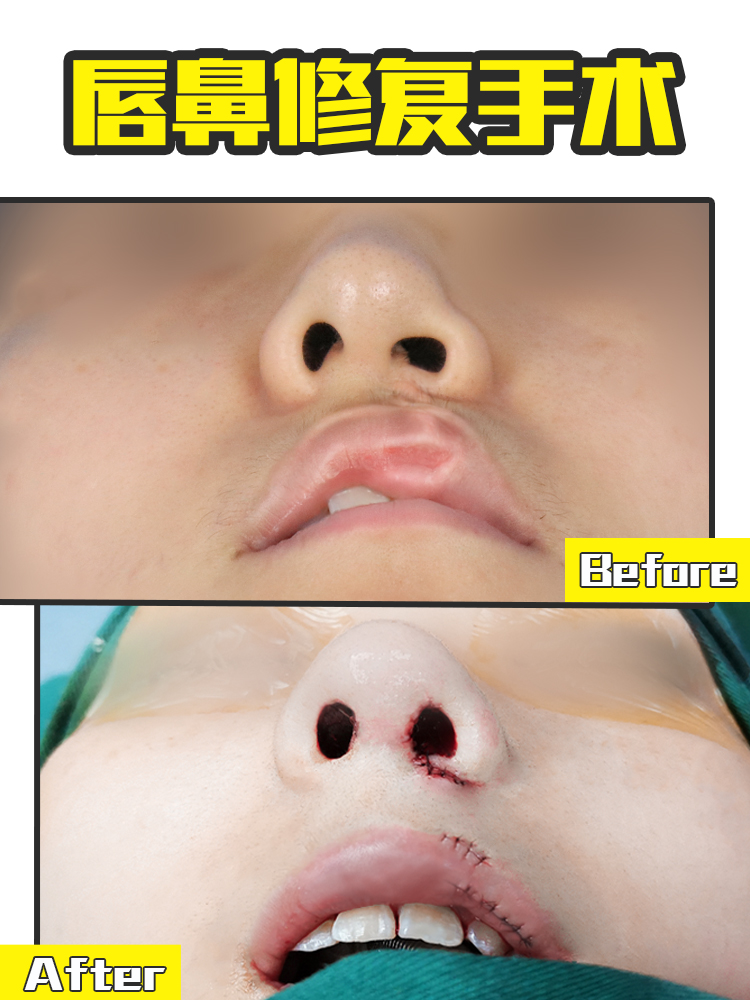 唇裂多少毫米才算严重