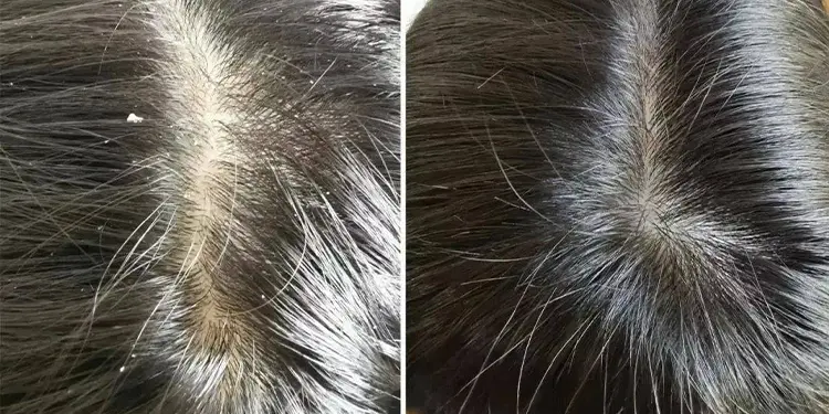 男人掉头发是什么原因引起的 哔哩哔哩