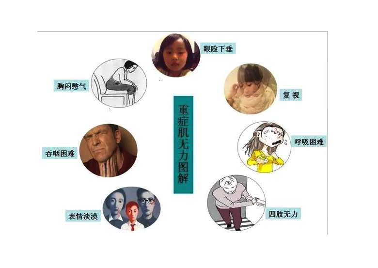 重症肌无力来了,来了,来了