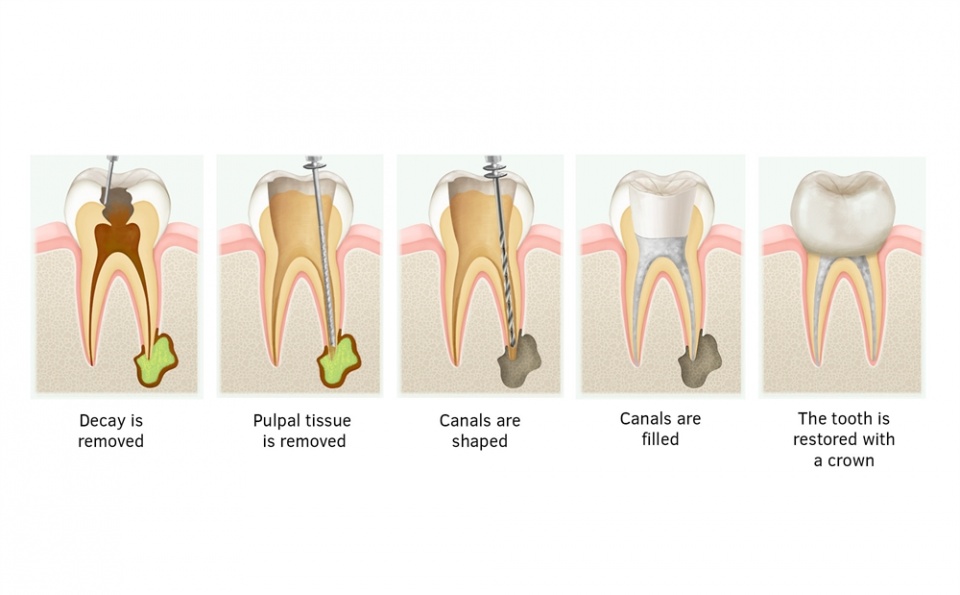 东莞中堂什么是根管治疗?牙齿出现这些情况,防止烂牙,建议做根管治疗