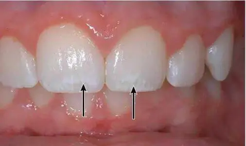 孩子牙齿上出现小白点 是蛀牙了吗 哔哩哔哩