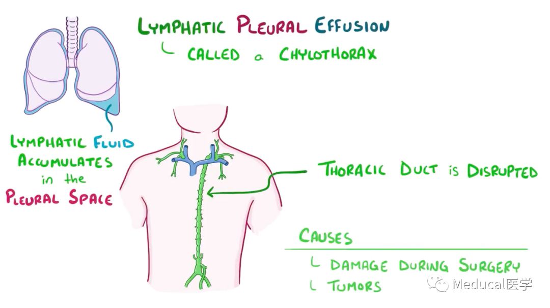 finally, there can be a  lymphatic pleural effusion, called a