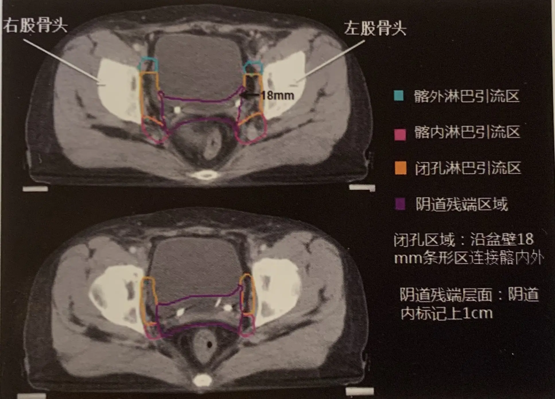 宫颈癌放疗图片大全集图片