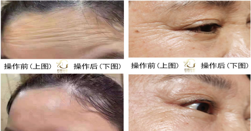 格耀佳泰,液态祛皱