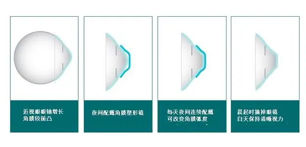 较真丨日本禁止20岁以下人群使用角膜塑形镜 却卖给中国 腾讯新闻