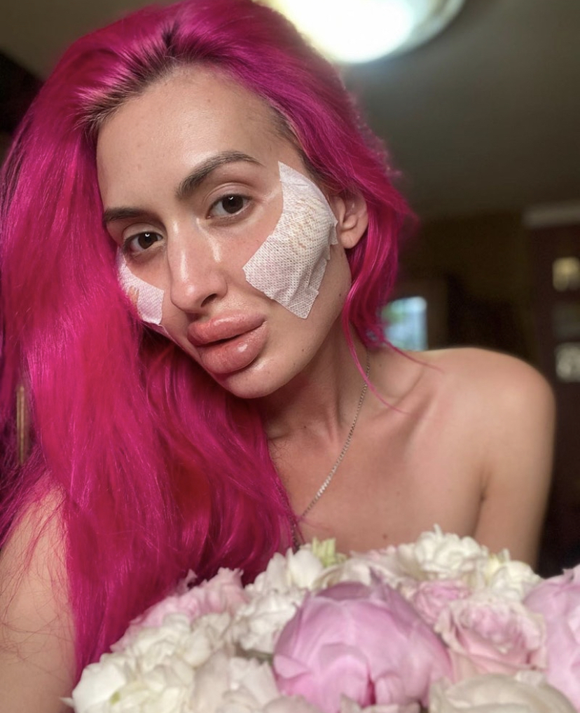 【这才是标准的网红脸】乌克兰网红整容致五官变形