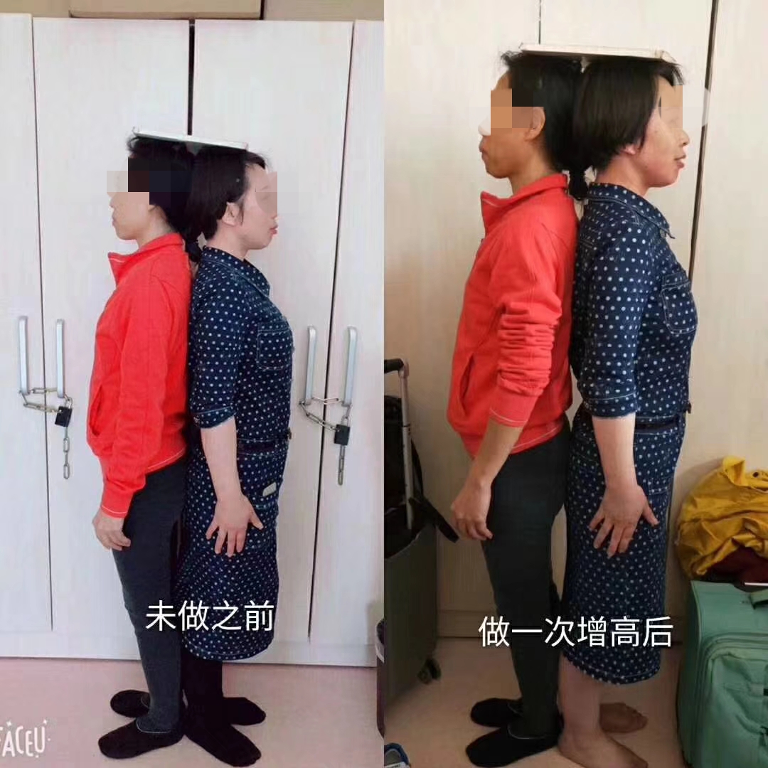 不限年龄增高术