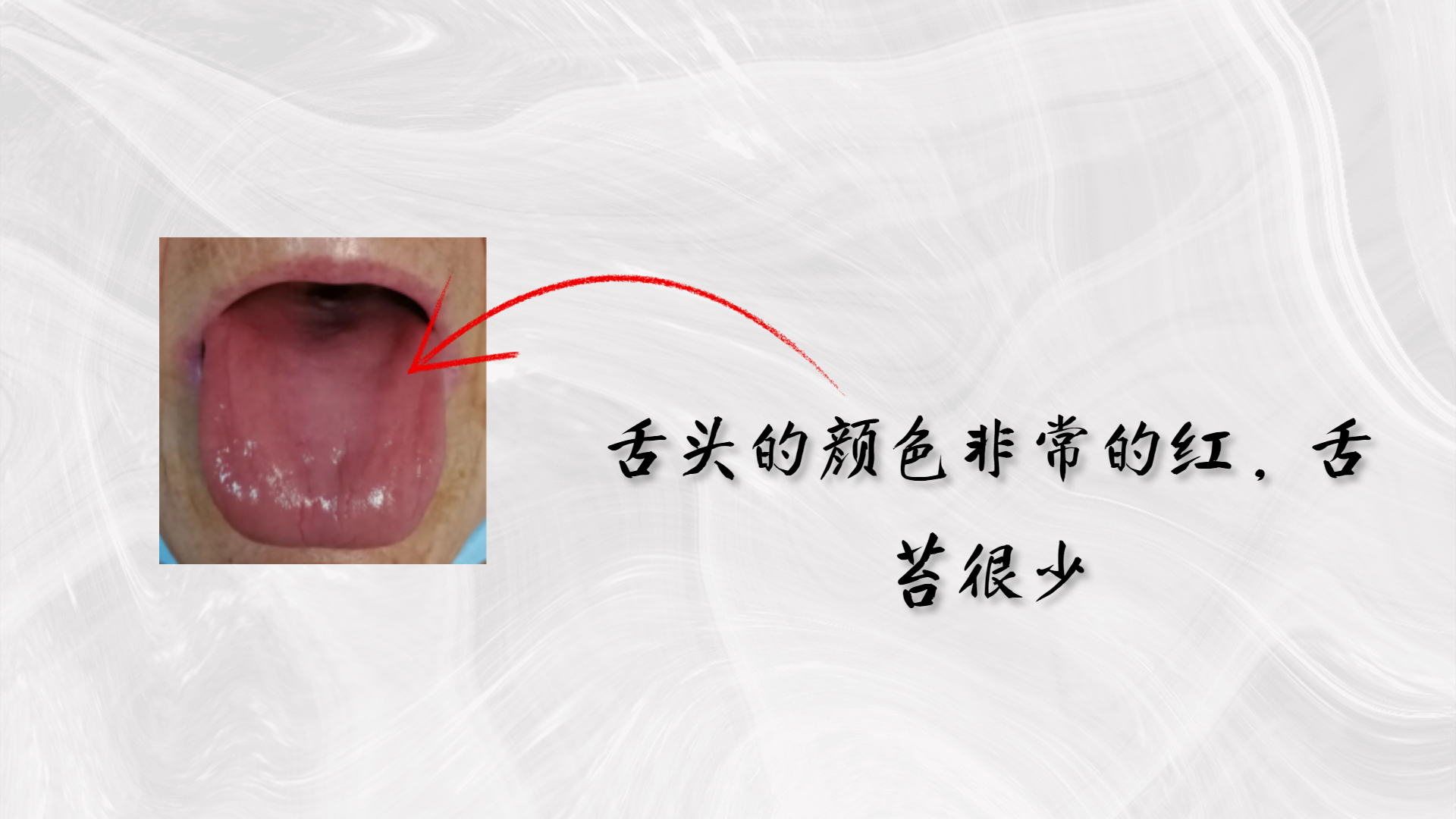 同样是肾虚，为什么舌苔不一样？屈医生分析下常见的4种肾虚舌象 - 知乎