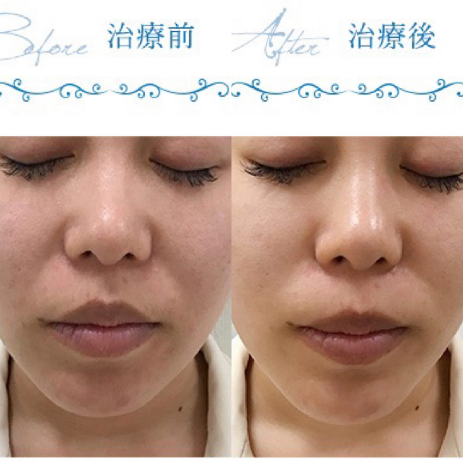超声刀脸肿吃什么药(超声刀脸肿吃什么药消肿快)