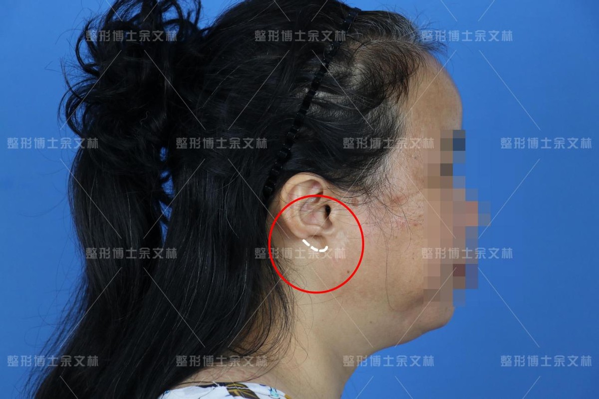 【案例分析】小姐姐生下来没有耳垂，为了戴耳环做耳垂修复 - 哔哩哔哩