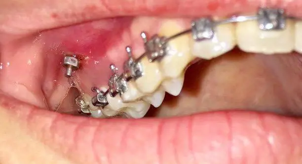 正畸科普 为什么矫正牙齿 需要打骨钉 哔哩哔哩