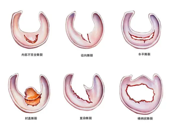 半月板损伤应该手术还是保守治疗 哔哩哔哩