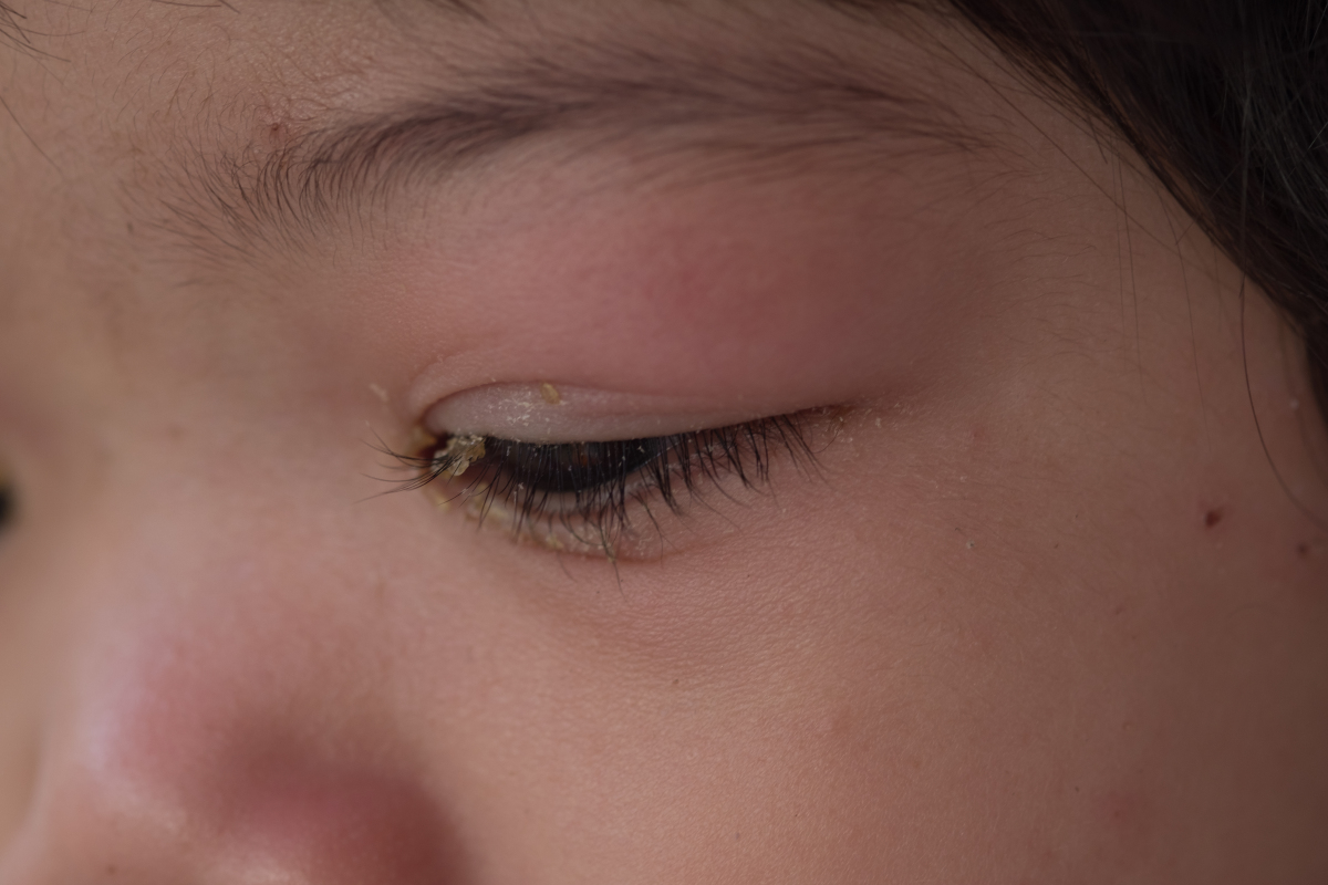 揉眼睛会导致视网膜脱落？经常揉眼睛还有这3大伤害 - 知乎