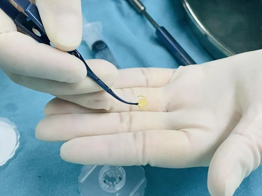 爱尔康vivity03 人工晶体植入在普瑞眼科医院完成 - 哔哩哔哩