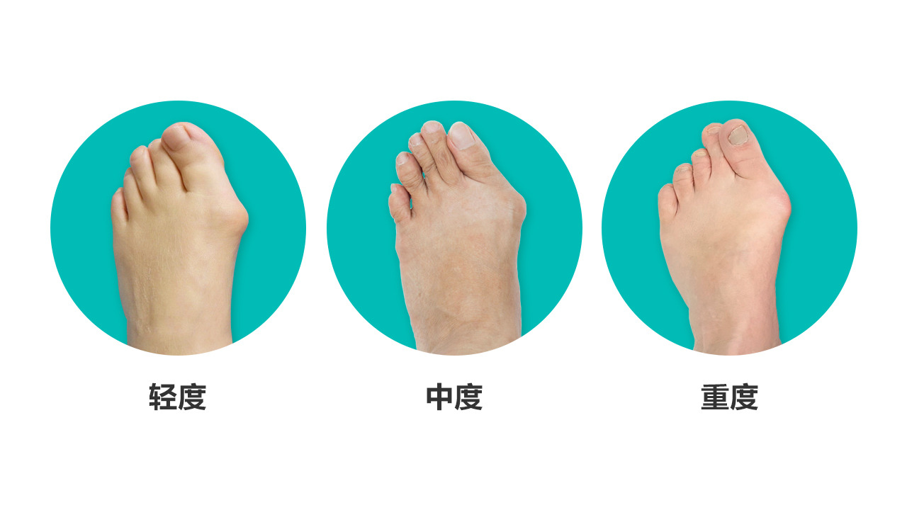 随大脚骨外翻程度的加重,大脚骨的症状表现为第1跖骨内翻也越来越严重