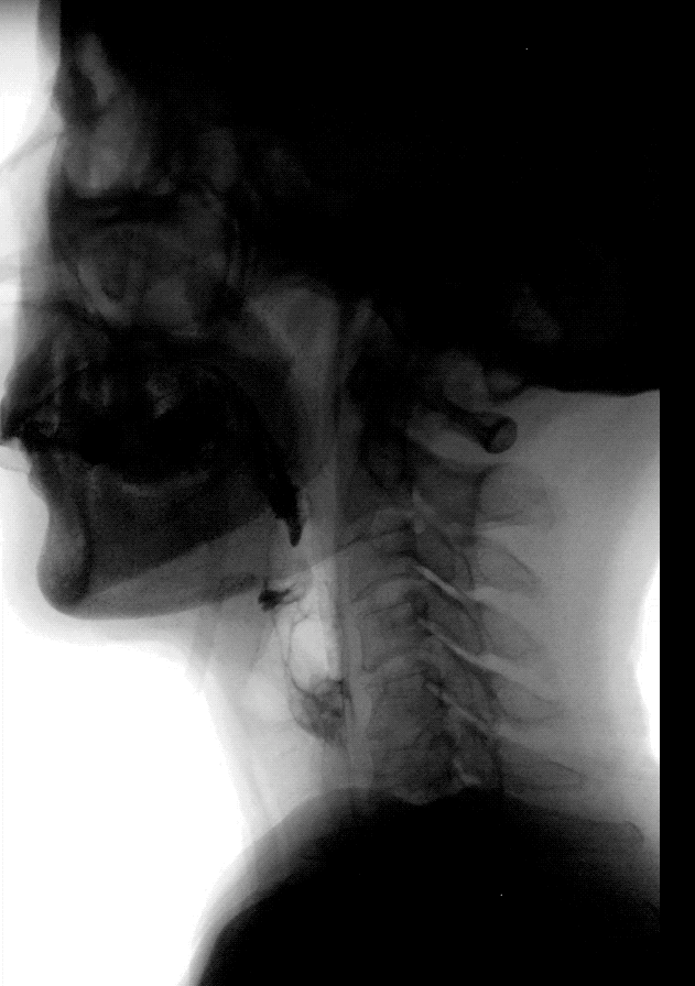 数字胃肠检查 方便快捷辐射小--- 让您的胃肠疾病无处隐身 - 哔哩哔哩