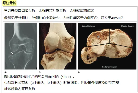 胫骨平台骨折三柱分类系统 骨科医生想要知道什么 哔哩哔哩