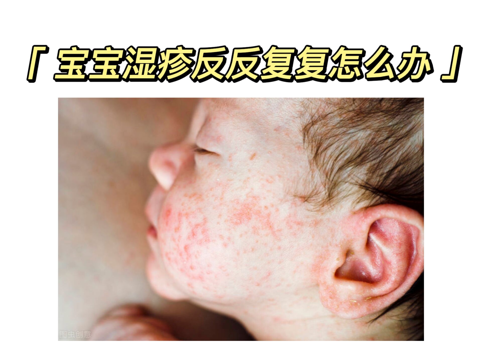 婴儿湿疹的家庭护理方法 - 哔哩哔哩