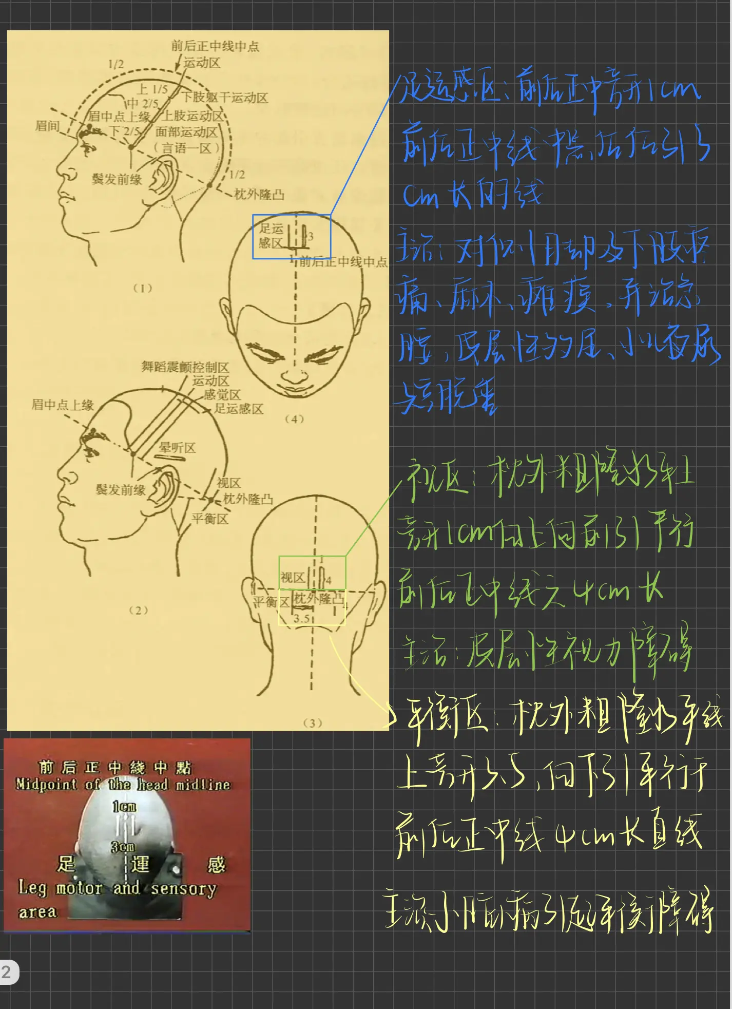 一针见效治疗偏瘫图解图片