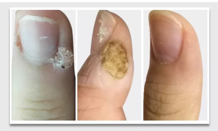 你不得不看的「甲疣」2.0 经典案例