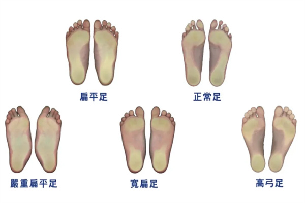 扁平足不能去当兵，这是真的吗？ 哔哩哔哩