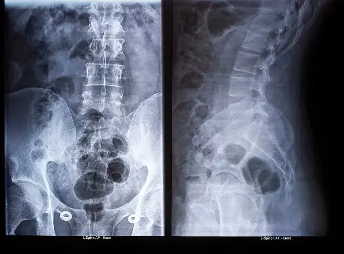 马尾神经损伤多久能恢复 哔哩哔哩