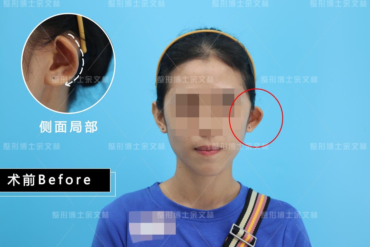 中国人の間で流行しているという耳の整形（エルフ耳） – ぱるぎょん