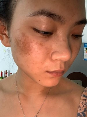 什么祛斑产品比较有效?是它!